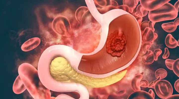 Early Warning Signs of Stomach CANCER People Ignore for Years