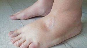 6 causes of water retention and how to reverse it